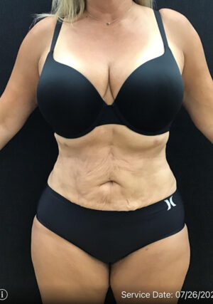 Liposuction