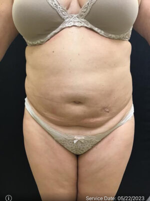 Liposuction