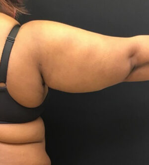 Tummy Tuck