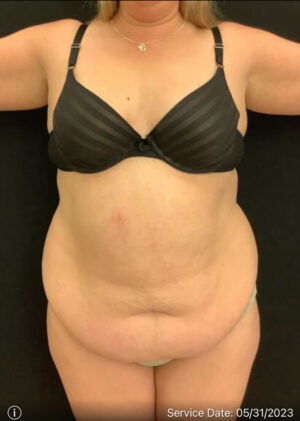 Tummy Tuck