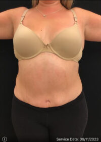 Tummy Tuck