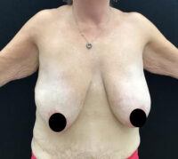 Breast Lift