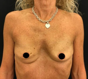 Breast Augmentation