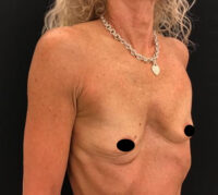 Breast Augmentation