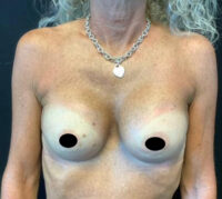 Breast Augmentation