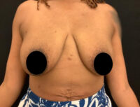 Breast Augmentation