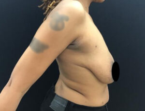 Breast Augmentation