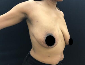 Breast Augmentation