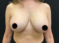 Breast Implant Removal