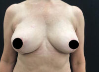 Breast Implant Removal