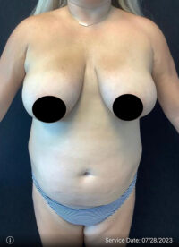 Breast Reduction