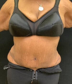 Tummy Tuck