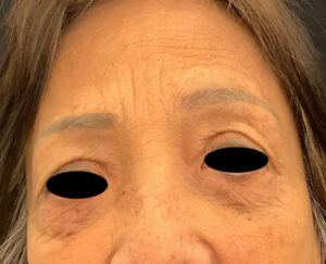 Eyelid Surgery