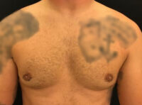 Gynecomastia