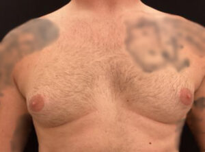 Gynecomastia