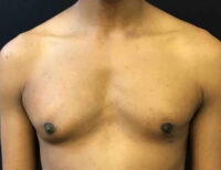 Gynecomastia