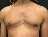 Gynecomastia