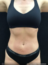 Liposuction