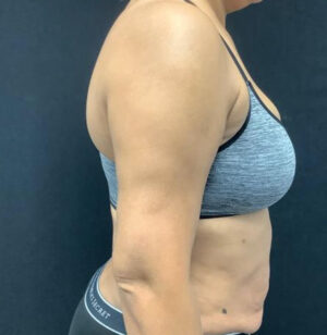 Liposuction