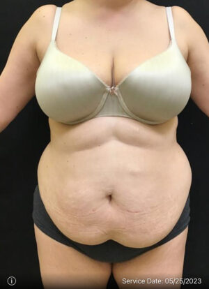 Liposuction