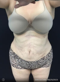 Liposuction