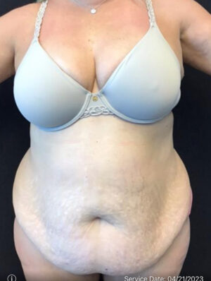 Liposuction