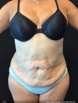 Liposuction