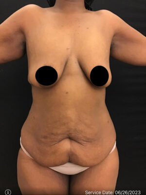 Panniculectomy