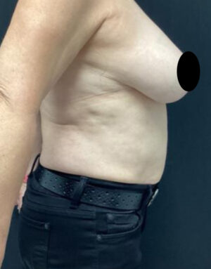 Breast Implant Removal