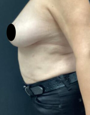 Breast Implant Removal