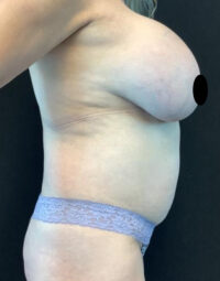 Breast Implant Removal