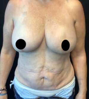 Breast Reconstruction