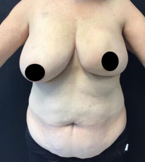 Breast Reconstruction