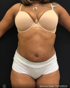 Tummy Tuck