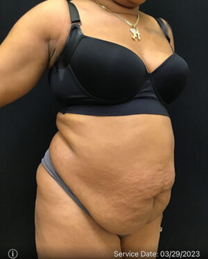 Tummy Tuck