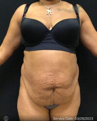 Tummy Tuck