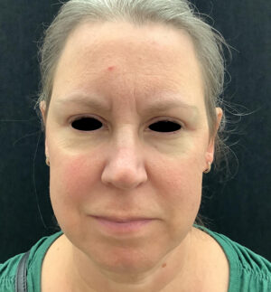 Upper Eyelid Blepharoplasty