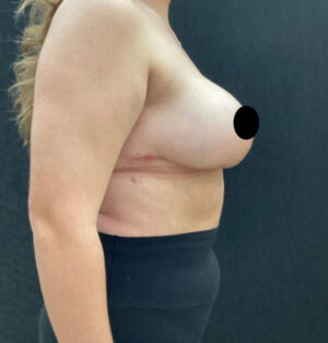 Breast Reduction