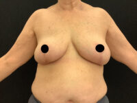 Breast Reduction