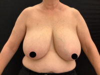 Breast Reduction