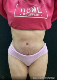 Tummy Tuck