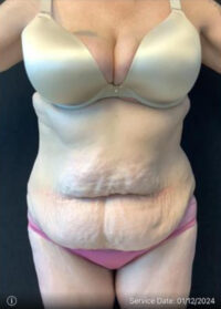 Tummy Tuck