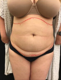 Liposuction