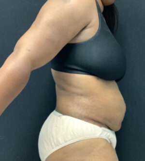 Liposuction