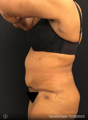 Liposuction