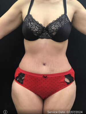 Tummy Tuck