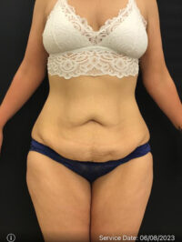 Tummy Tuck