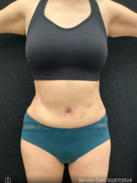 Tummy Tuck