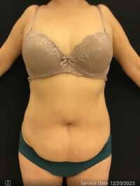 Tummy Tuck