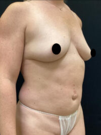 Breast Augmentation